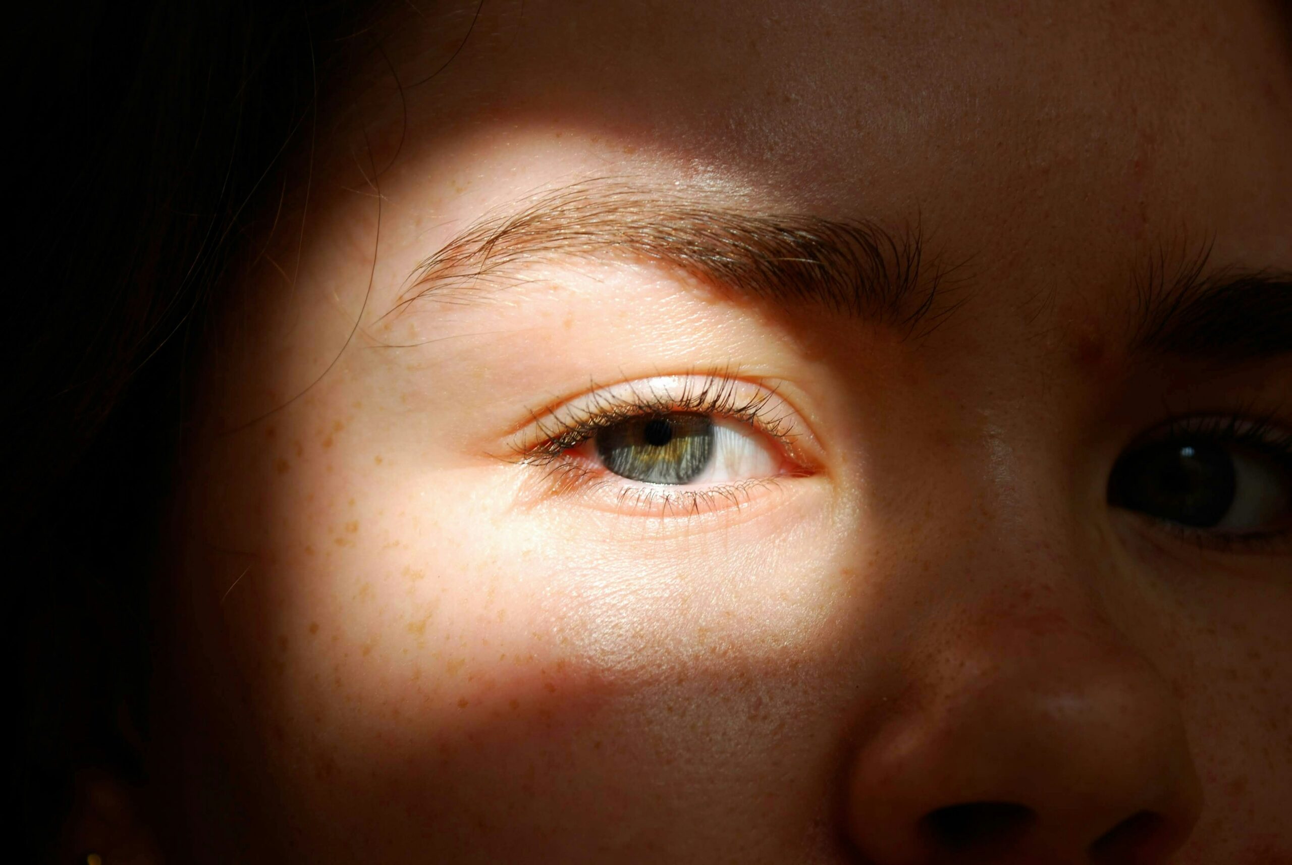 Dark Spots On Your Face? Everything To Know About Hyperpigmentation