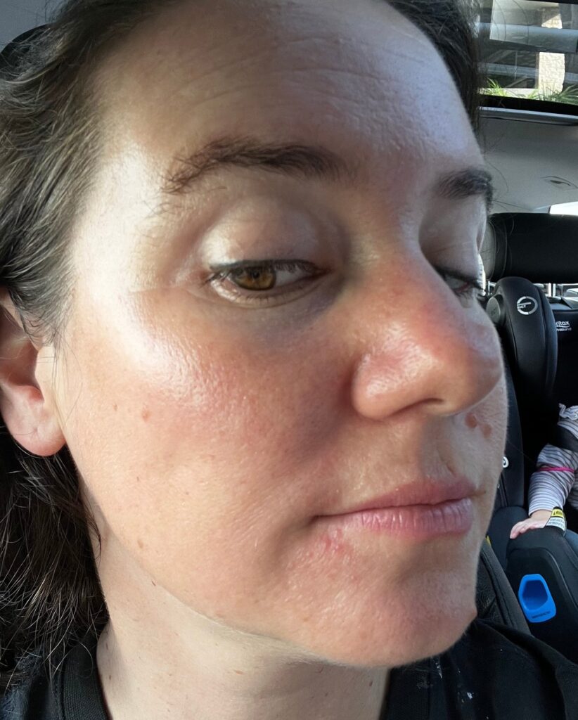 rosacea skin concern