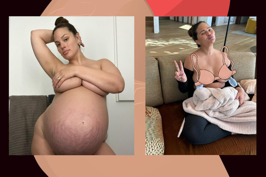 stretchmarks