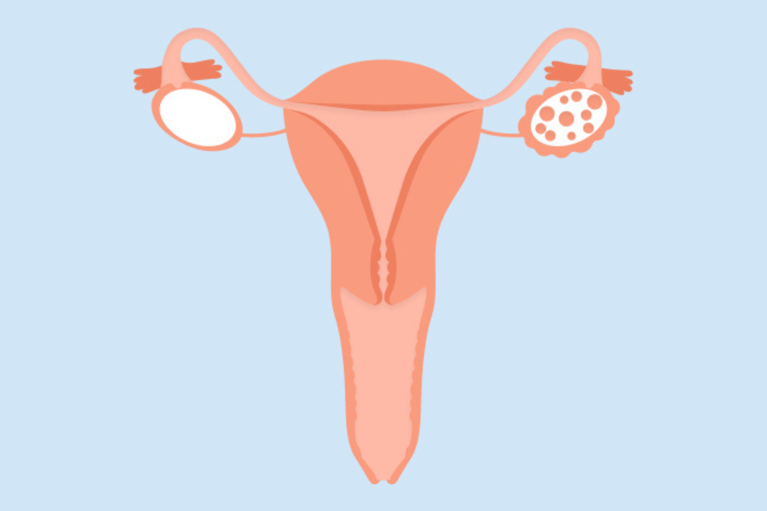 How To Spot The Signs And Symptoms Of PCOS — And Manage Them